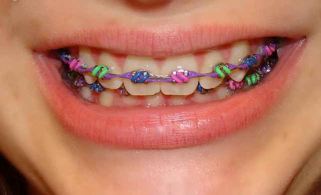 Cool Braces Colours