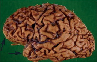 Frontal Lobe Dementia Wiki