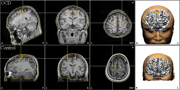 Frontal Lobe Syndrome 310.0