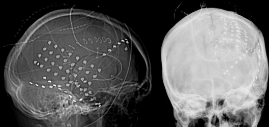 Frontal Lobe Syndrome 310.0