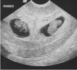 Identical Twins Pregnancy Problems