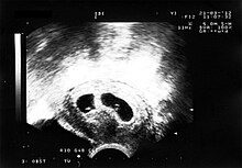 Identical Twins Pregnancy Problems