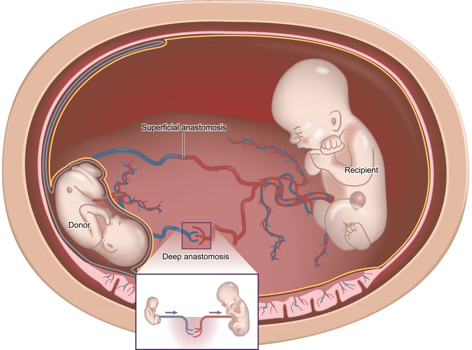 Identical Twins Pregnancy Problems