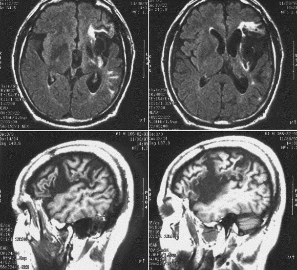 Left Frontal Lobe Damage