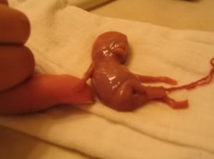 Miscarriage At 12 Weeks At Home