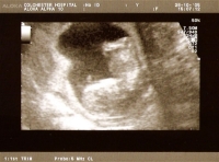 Miscarriage At 12 Weeks At Home