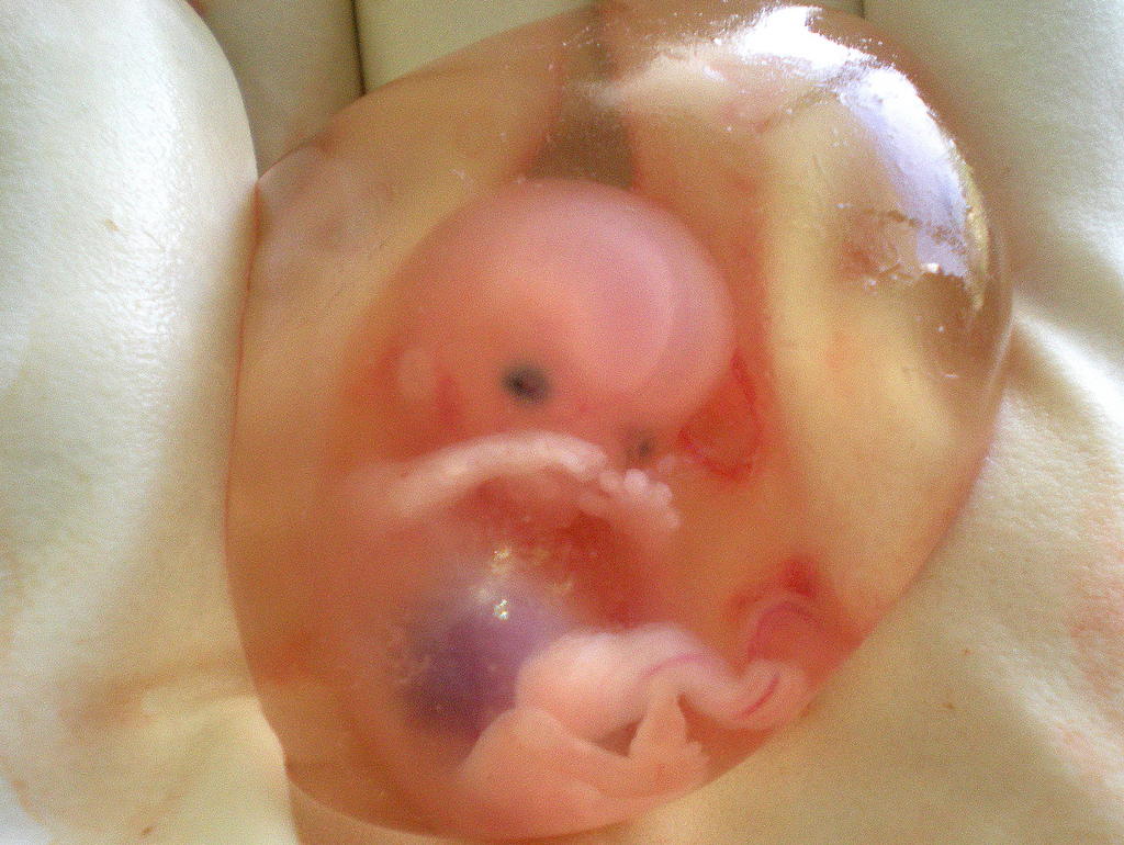 Miscarriage At 7 Weeks What To Expect
