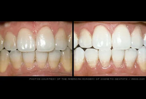 Pictures Of Healthy Gums And Teeth