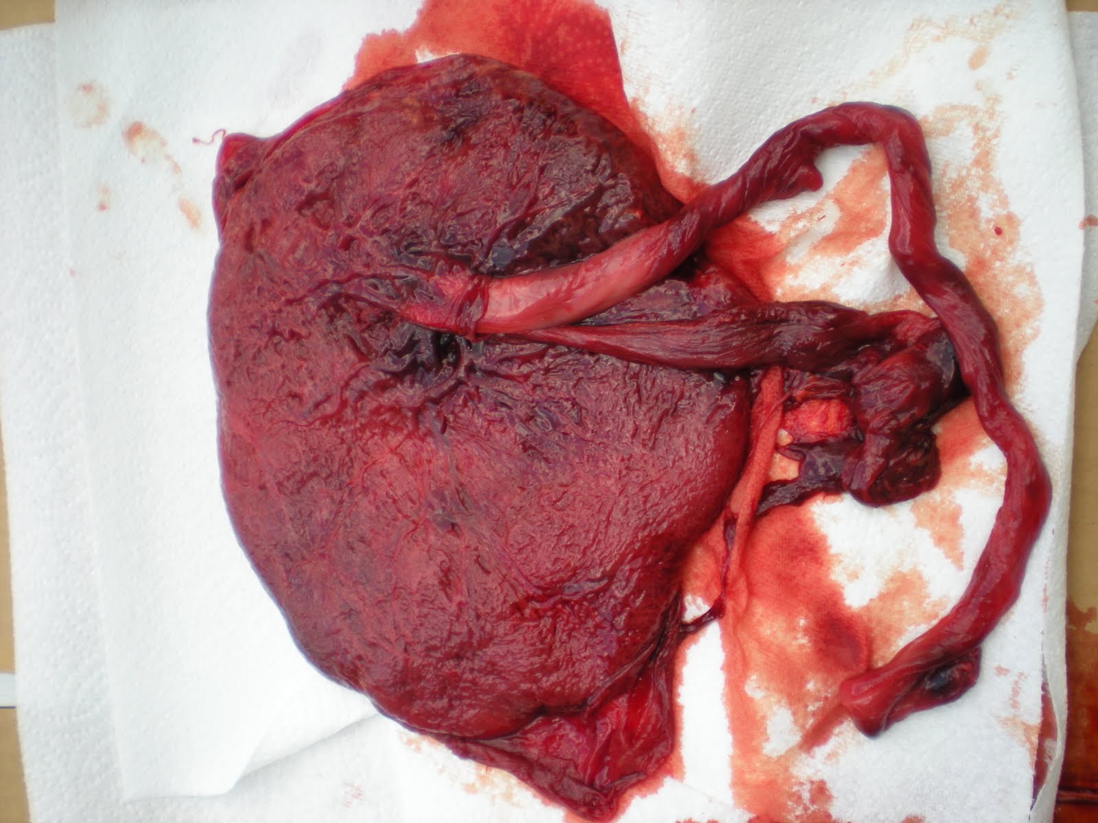 Placenta