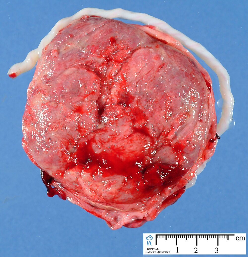Placenta