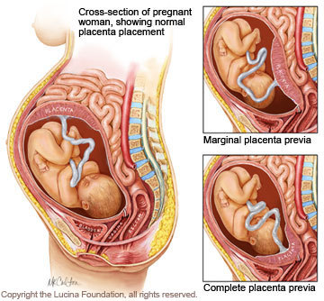 Placenta Praevia