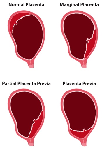 Placenta Praevia