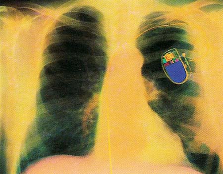 Plutonium Battery Pacemaker