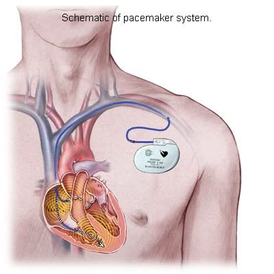 Plutonium Battery Pacemaker