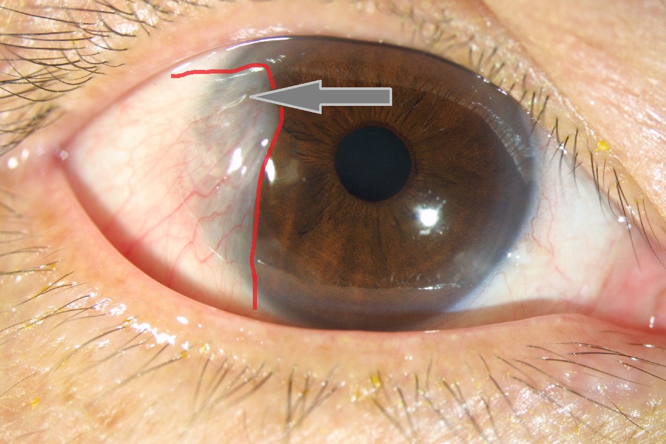 Pterygium Eye