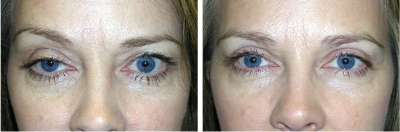 Ptosis Repair