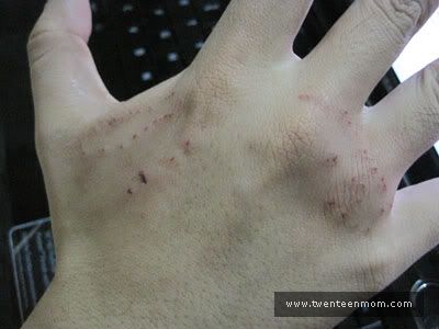Python Snake Bite