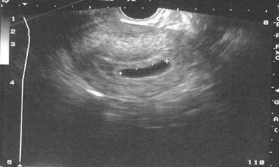 Retained Products Of Conception After Abortion