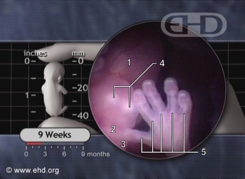 Retained Products Of Conception After Abortion
